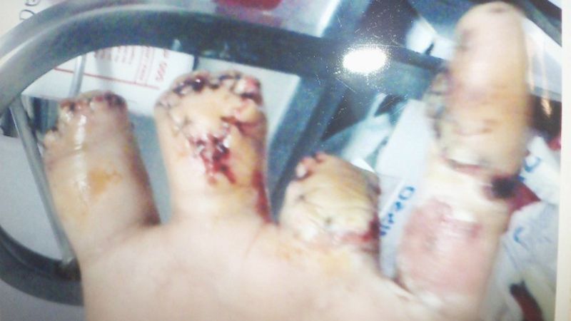 Operario textil sufrió un grave accidente