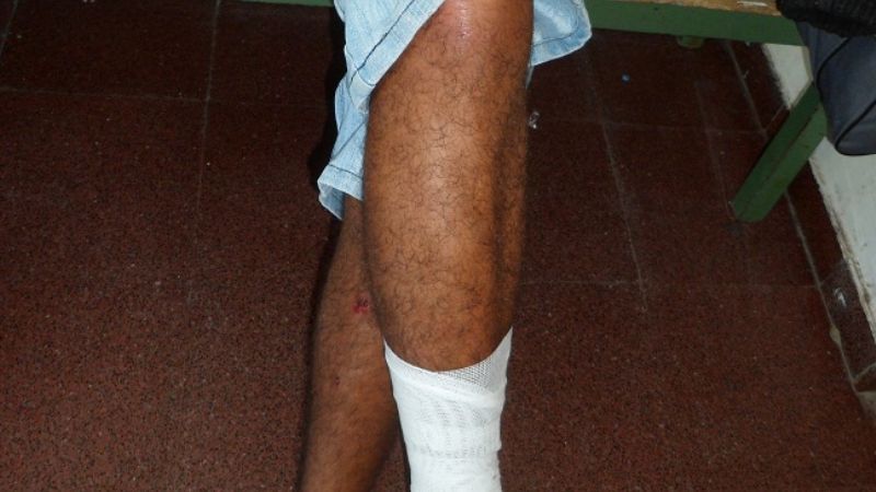 Le fracturó el tobillo y se fugó