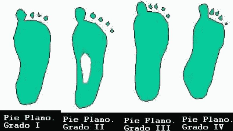 Campaña de diagnóstico de pie plano