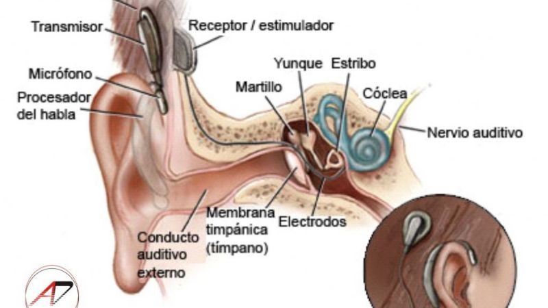 Joven fiambalense se someterá a una operación de implante coclear