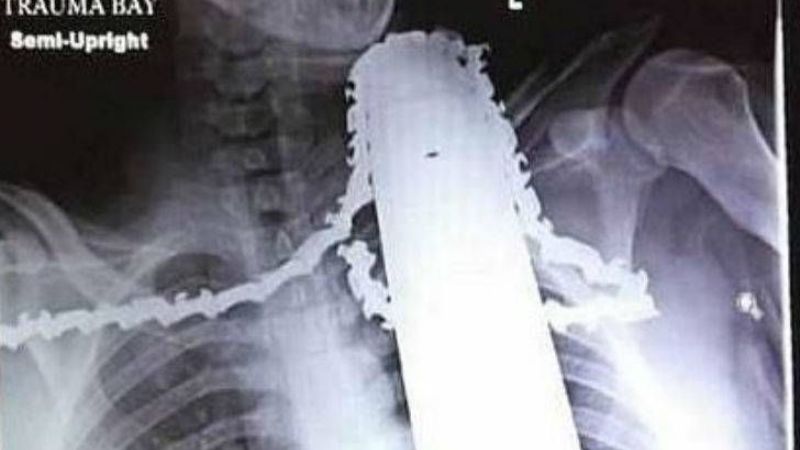 Una motosierra le perforó el cuello y sobrevivió