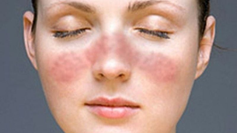 “Catamarca Unida por el Lupus”