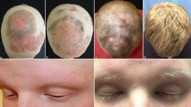 ¿Encontraron la cura contra la calvicie?