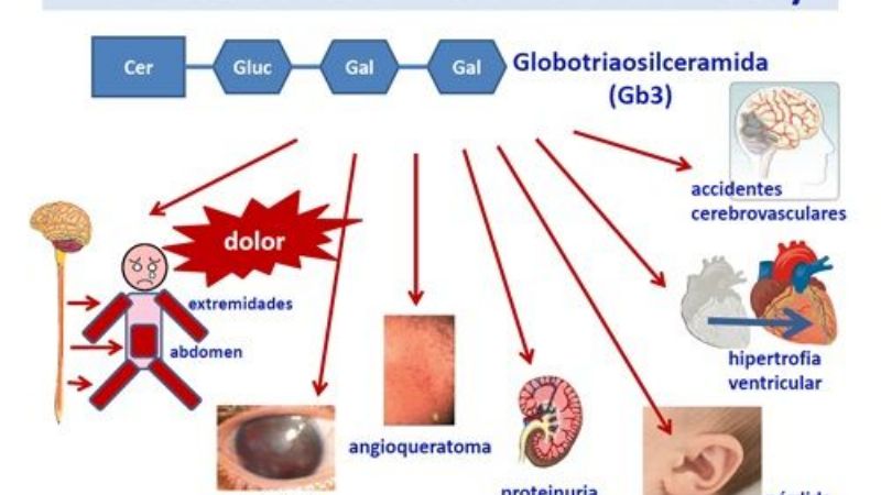 Abrió en Catamarca exposición para concientizar sobre la enfermedad de Fabry