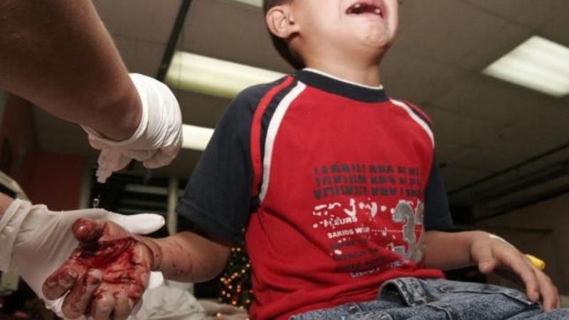 Un niño santamariano perdió dos dedos por la pirotecnia