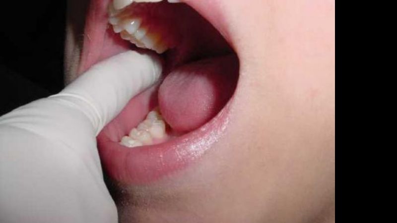 Este 5 de diciembre será de concientización sobre la lucha contra el Cáncer Bucal