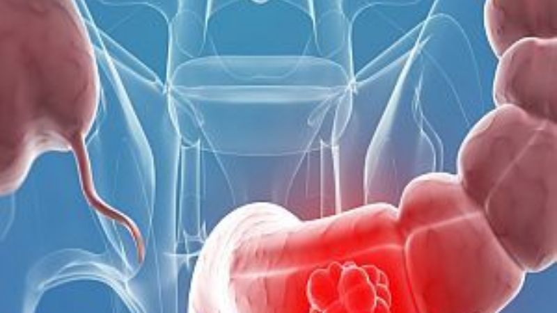 Claves para prevenir el cáncer colorrectal