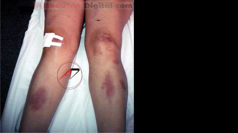 Empeoró el estado de salud de la docente brutalmente agredida