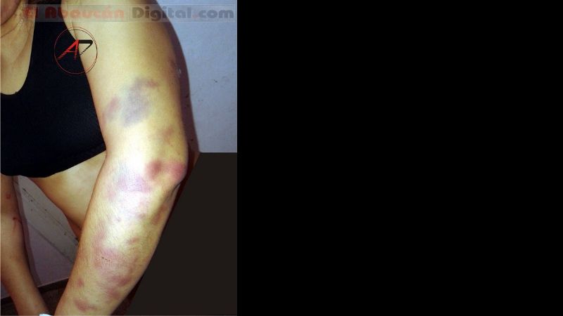 Empeoró el estado de salud de la docente brutalmente agredida