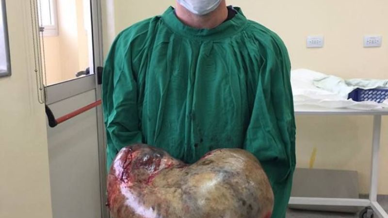 En operación de alta complejidad, le sustrajeron un tumor de 15 kilos