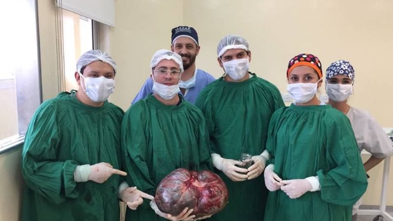 En operación de alta complejidad, le sustrajeron un tumor de 15 kilos