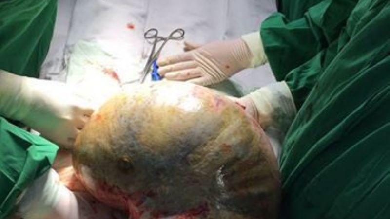 En operación de alta complejidad, le sustrajeron un tumor de 15 kilos
