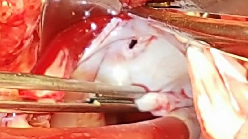 Exitosa cirugía de alta complejidad