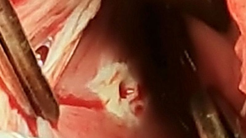 Exitosa cirugía de alta complejidad