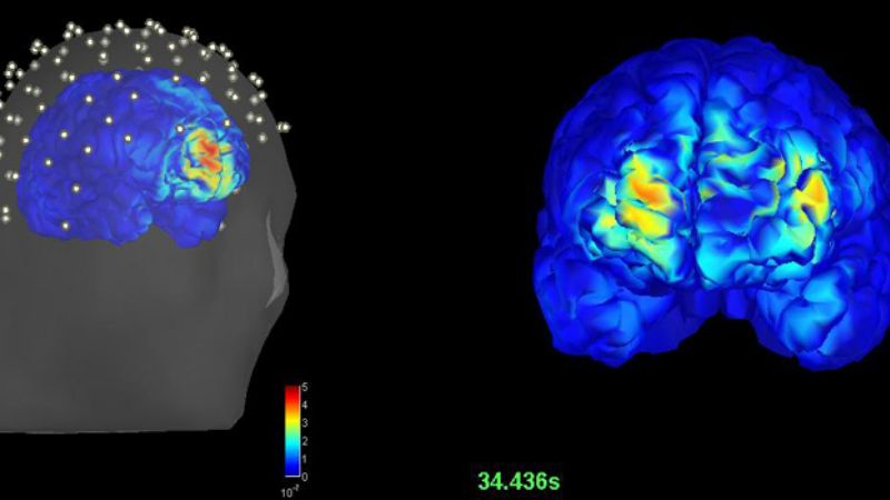 Nuevo modo de detectar epilepsia sin intervención quirúrgica