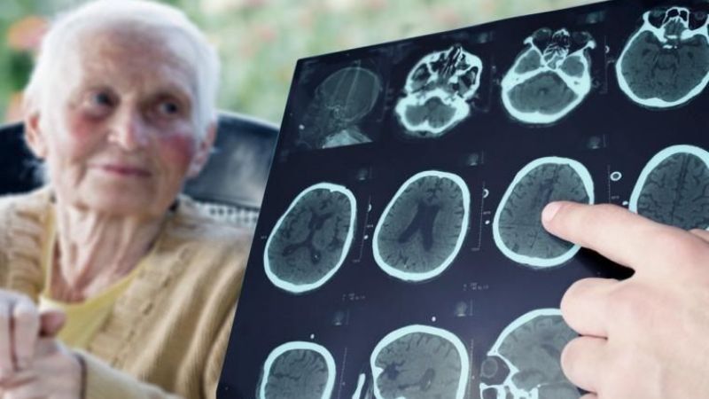 Científicos argentinos buscan revelar la "firma molecular" del Alzheimer
