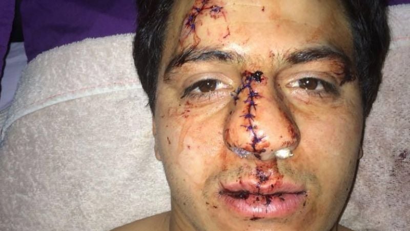 Le desfiguraron el rostro en un boliche