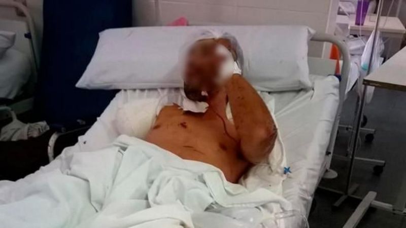 Entró a robar, lo atacó un pitbull y debieron amputarle un brazo