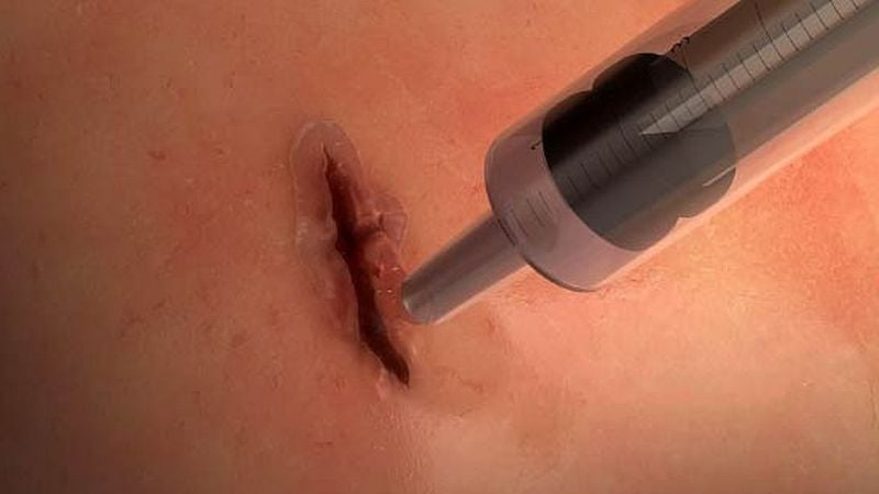 Desarrollan revolucionario pegamento para reparar tejidos