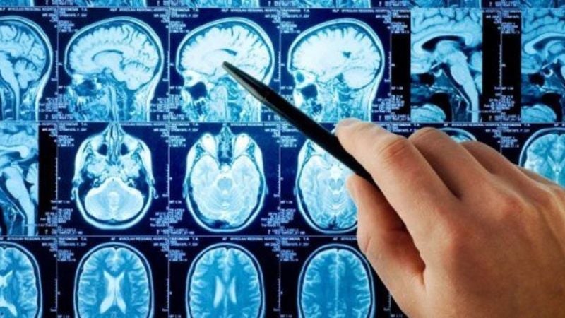El cerebro del hombre envejece peor que el de la mujer