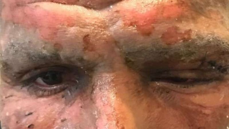 Viatri se quemó la cara al explotarle un petardo en Navidad