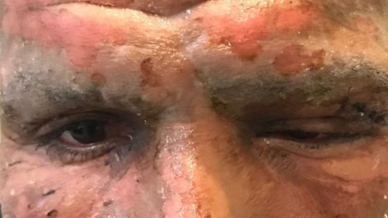 Jugador de fútbol quedó desfigurado por la explosión de un petardo en la cara