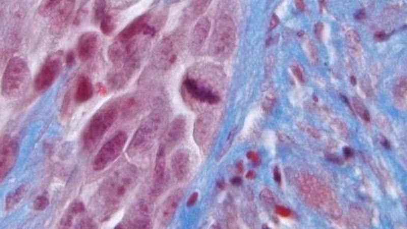 Nanopartículas, una potencial ayuda contra el cáncer