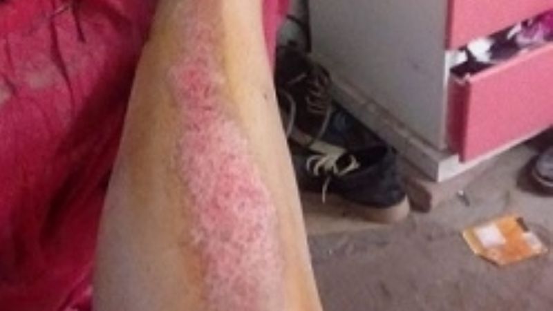 Se desvaneció mientras manejaba la moto y sufrió graves heridas