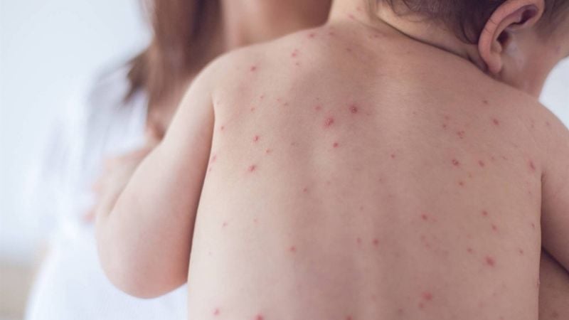 Confirmaron un caso de sarampión en Buenos Aires