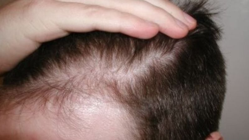 Científicos hallan en la jarilla la clave contra la calvicie