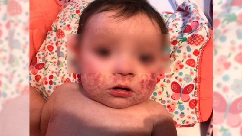 Lanzan alerta epidemiológico por dos casos de sarampión autóctonos