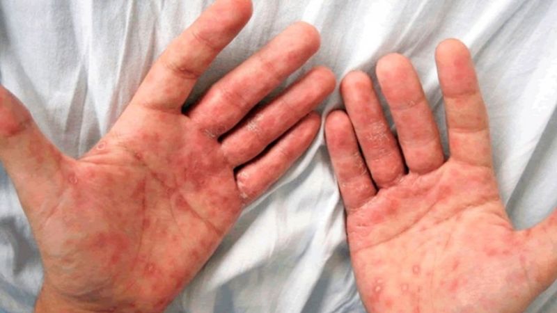 Preocupación de médicos por el aumento de sífilis en el país