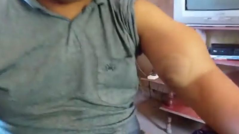 Se le quebró la prótesis y pide ayuda