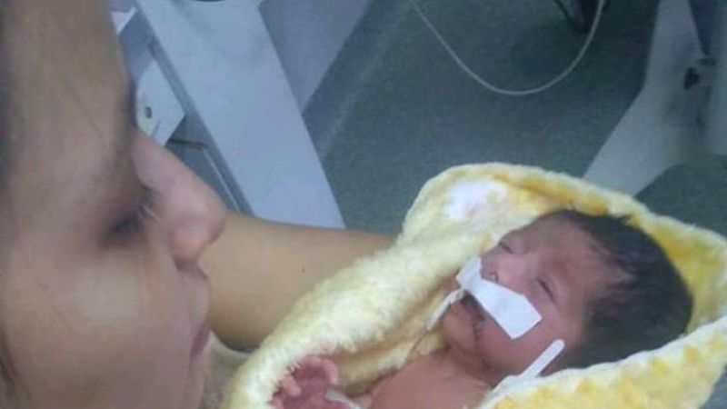 Denuncian que le cortaron la boca a una beba en una cesárea