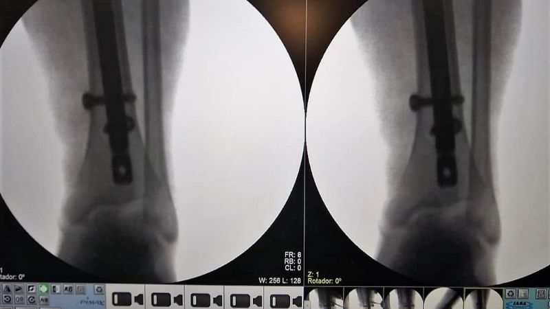 Compleja operación en el Hospital Recreo