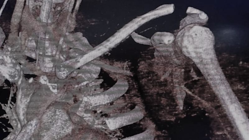 Se realizaron cirugías de Bypass en el Hospital San Juan