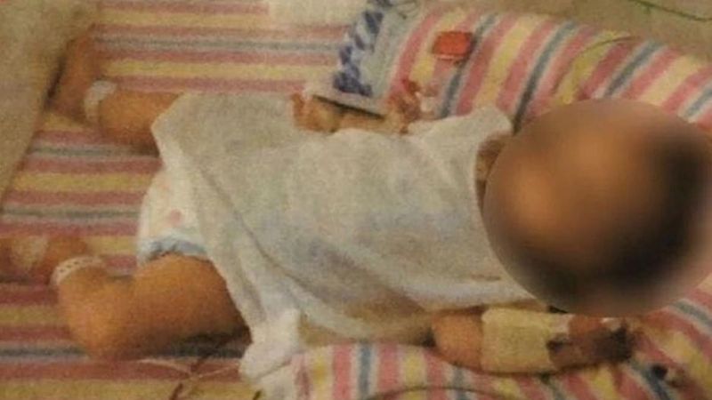 Sometieron a beba a dieta vegana y sufrió una desnutrición que compromete su desarrollo