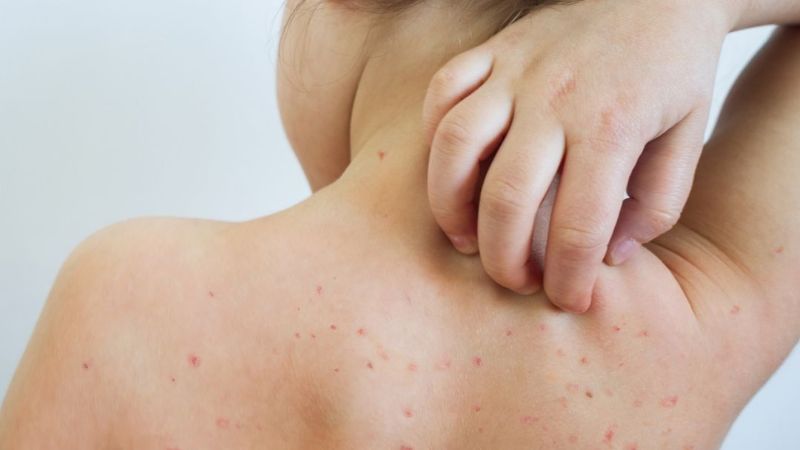 Recomendaciones ante alerta de sarampión y fiebre amarilla para viajeros