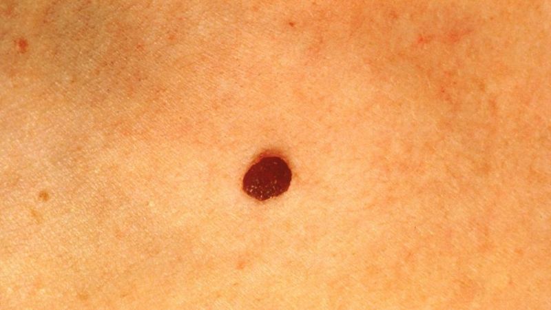 Alertan que el melanoma mata a 550 argentinos por año
