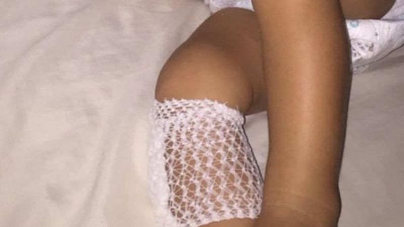 Polémica por quemaduras de niños en puente de Carlos Paz