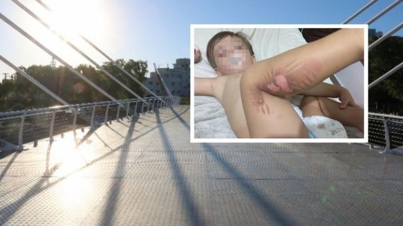 Polémica por quemaduras de niños en puente de Carlos Paz