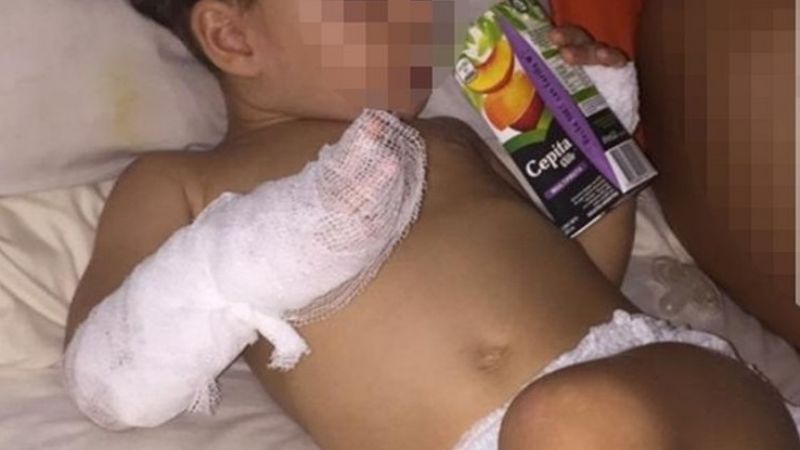 Polémica por quemaduras de niños en puente de Carlos Paz