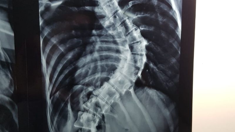 Exitosa cirugía de columna en el Hospital San Juan Bautista