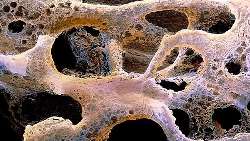 La pandemia incrementó la fragilidad en personas con osteoporosis