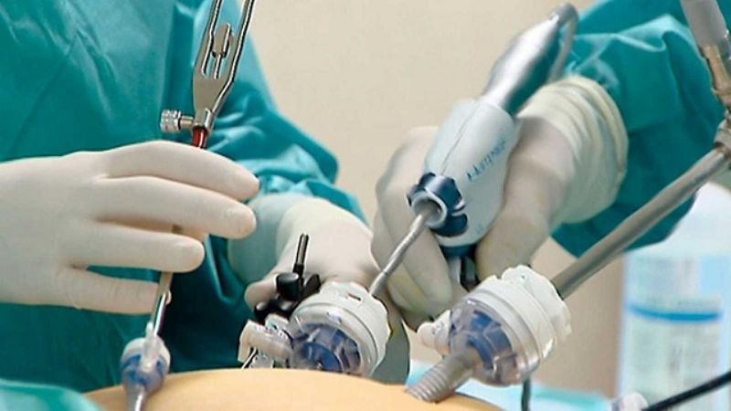 Primera cirugía videolaparoscópica de un pseudoquiste pancreático