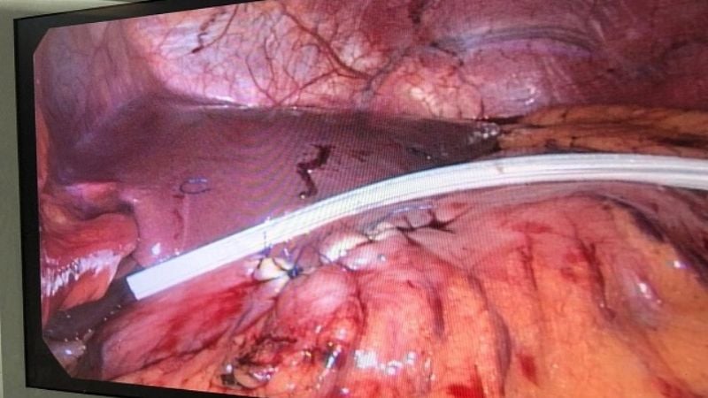 Primera cirugía videolaparoscópica de un pseudoquiste pancreático