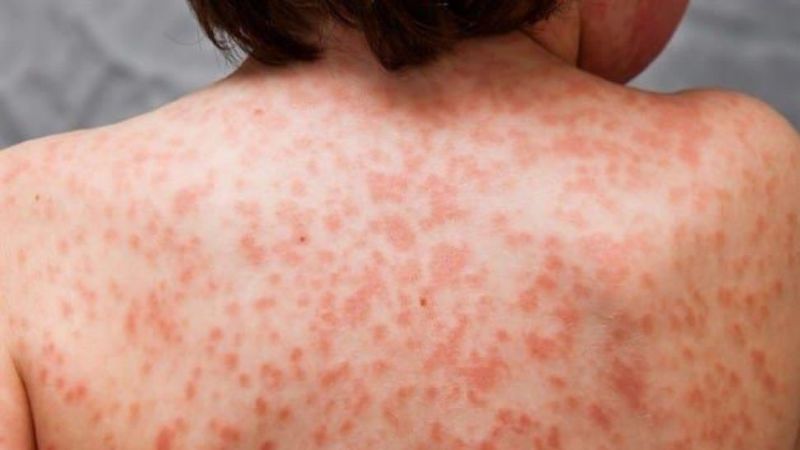 La enfermedad de Kawasaki, vinculada al coronavirus