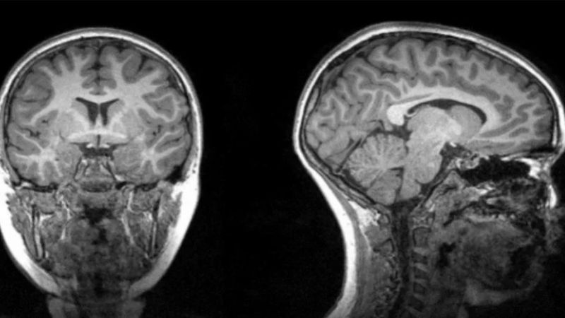 Un estudio revela que el Covid alteraría el tamaño de la materia gris