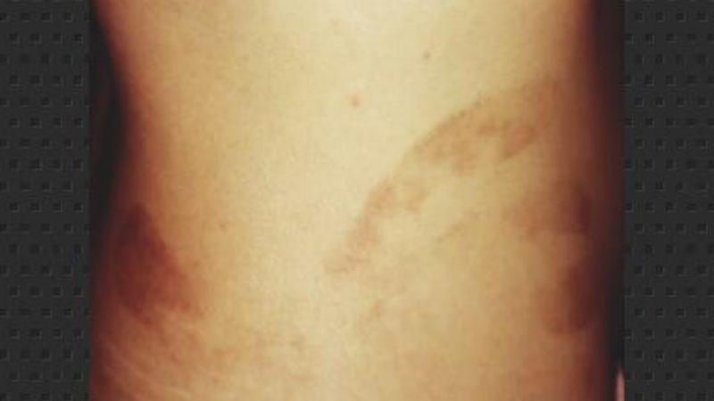 La espantada, un caso poltergeist en un sanatorio de Catamarca