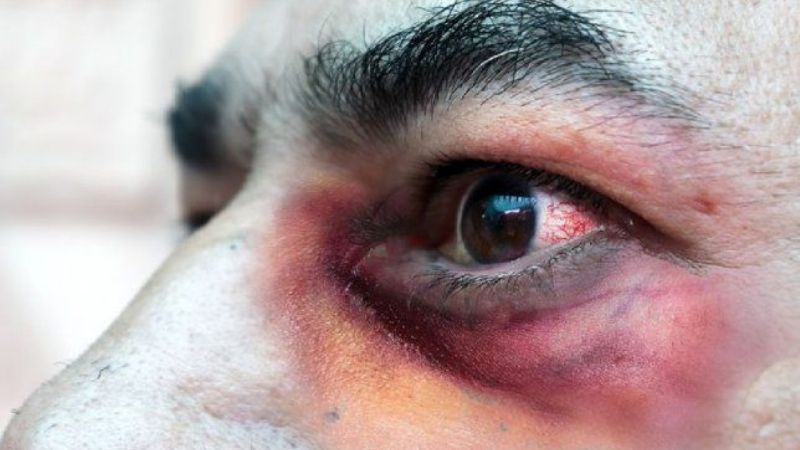 Primer muerto por "hongo negro" en Argentina